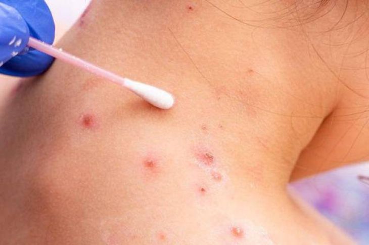  Salud llevó tranquilidad respecto de un posible caso sospechoso de viruela símica en Comodoro Rivadavia